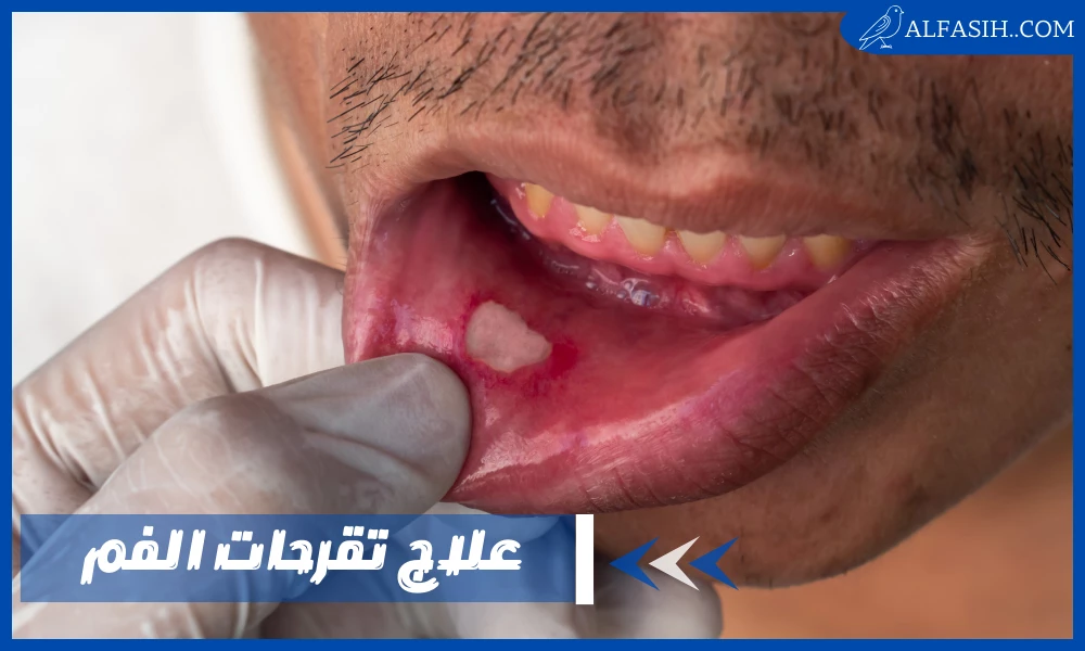 علاج تقرحات الفم