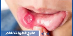 طرق علاج فطريات الفم للكبار والصغار