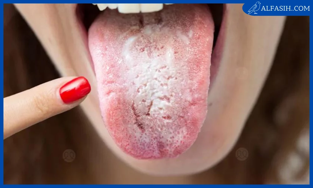 علاج فطريات الفم 