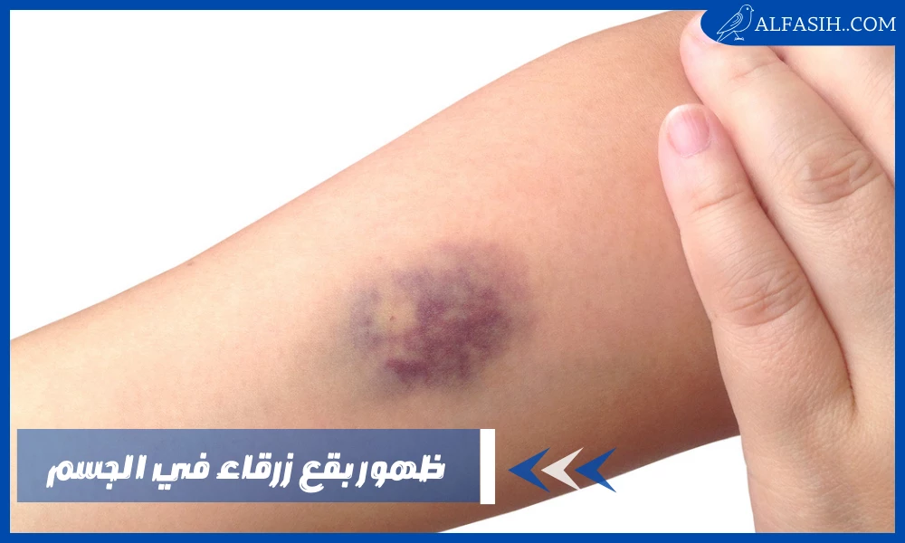 ظهور بقع زرقاء في الجسم عند النساء