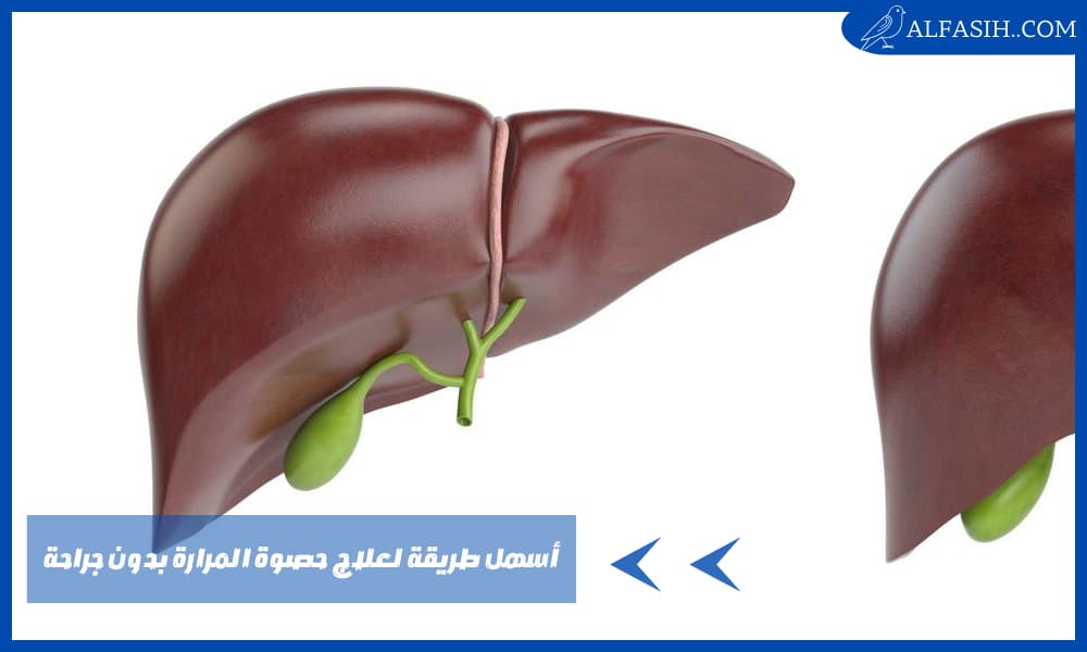 أسهل طريقة لعلاج حصوة المرارة بدون جراحة