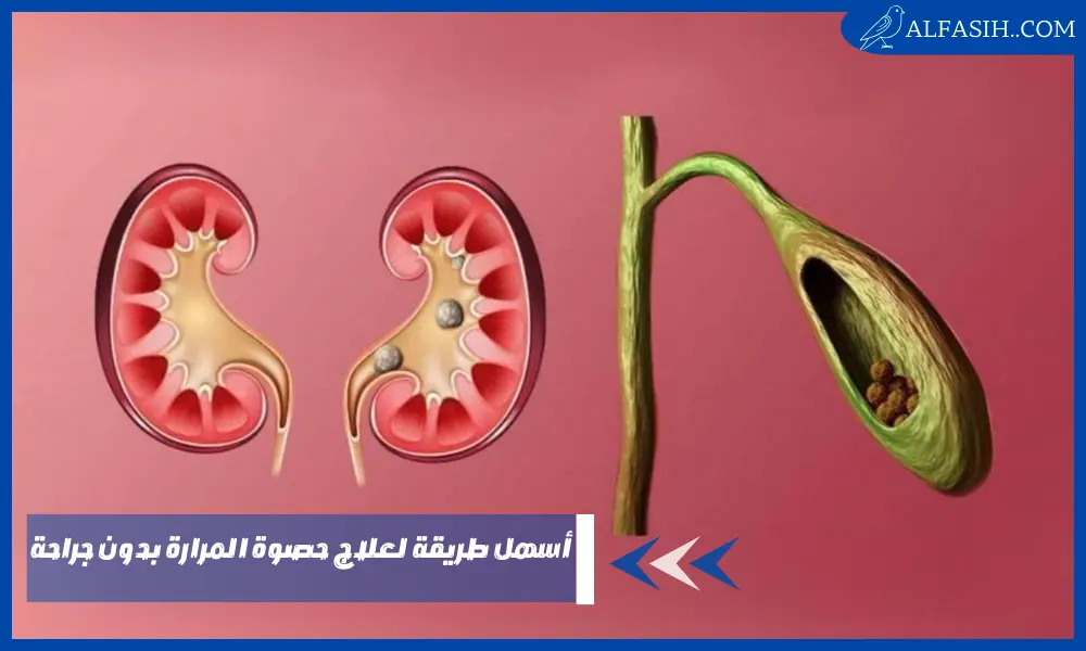 أسهل طريقة لعلاج حصوة المرارة بدون جراحة