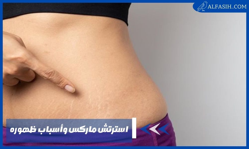 استرتش ماركس وأسباب ظهوره وهل يمكن علاجها دون جراحة؟