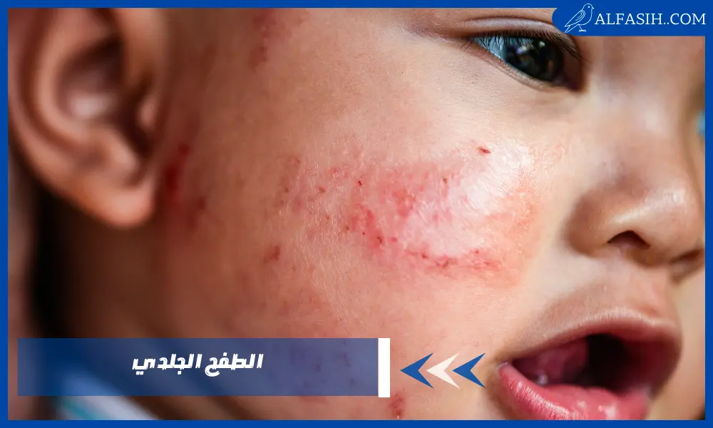 أسباب ظهور الطفح الجلدي المفاجئ للأطفال Contact dermatitis