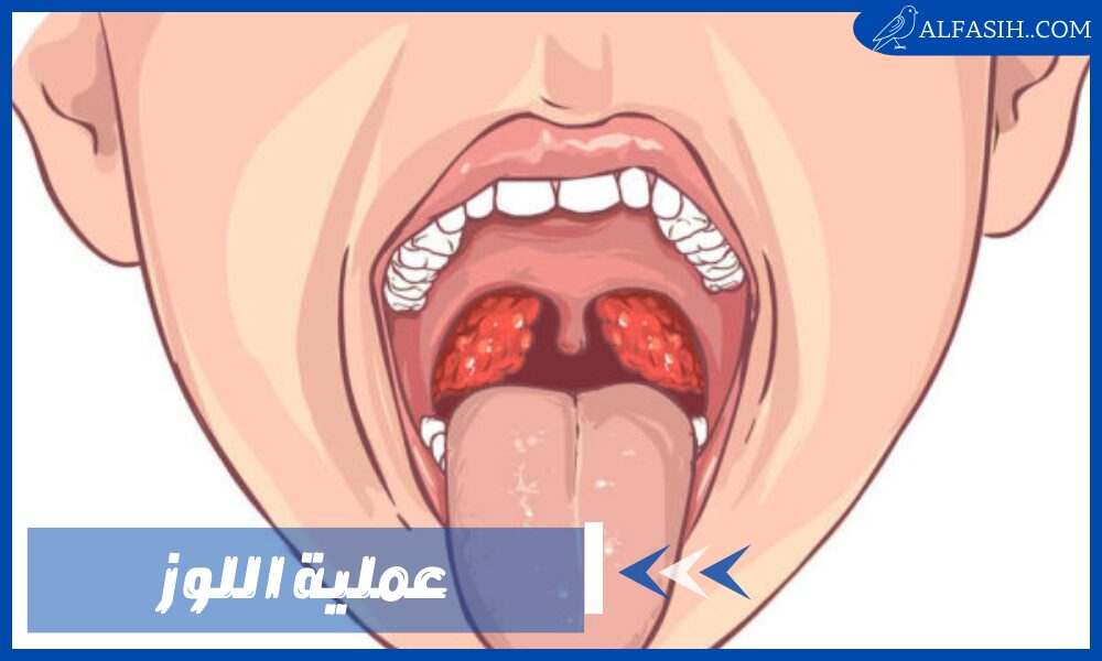 عملية اللوز