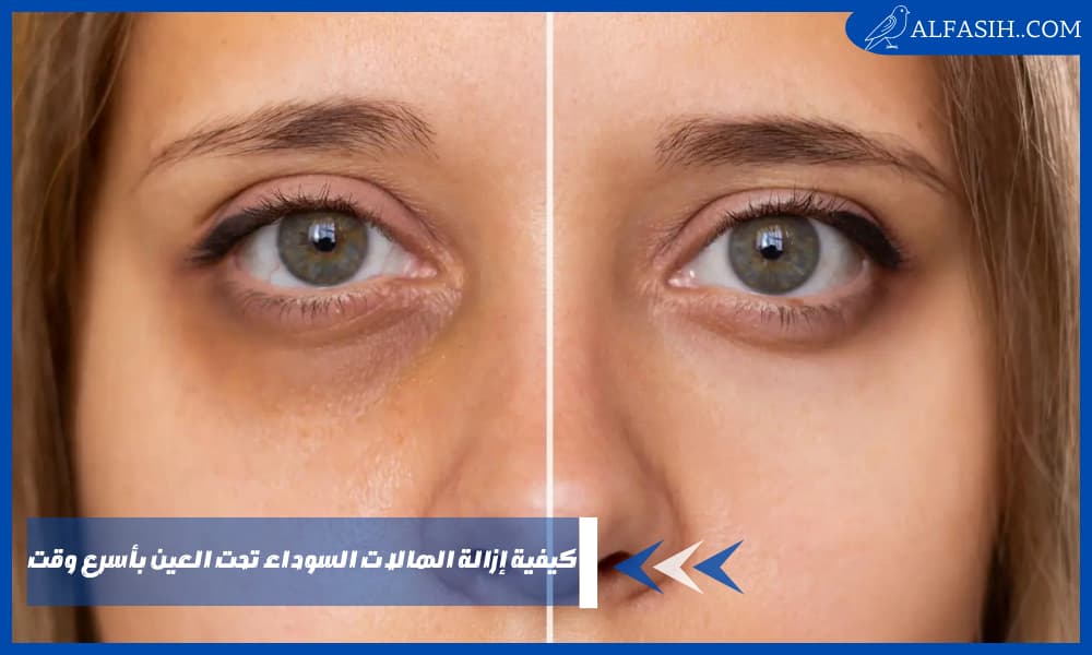 كيفية إزالة الهالات السوداء تحت العين بأسرع وقت