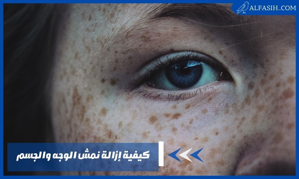 كيفية إزالة نمش الوجه والجسم