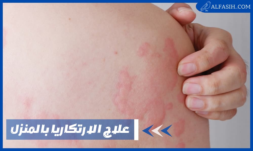 هل يمكن علاج الارتكاريا بالمنزل