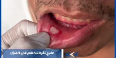 دون الحاجة للذهاب للطبيب – علاج تقرحات الفم في المنزل