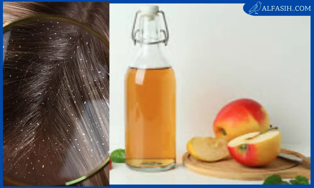 كيف استعمل خل التفاح لعلاج قشرة الشعر1