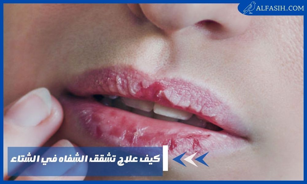 كيف علاج تشقق الشفاه في الشتاء 1