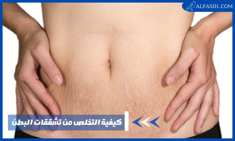 كيفية التخلص من تشققات البطن وأسباب ظهورها وأنواعها