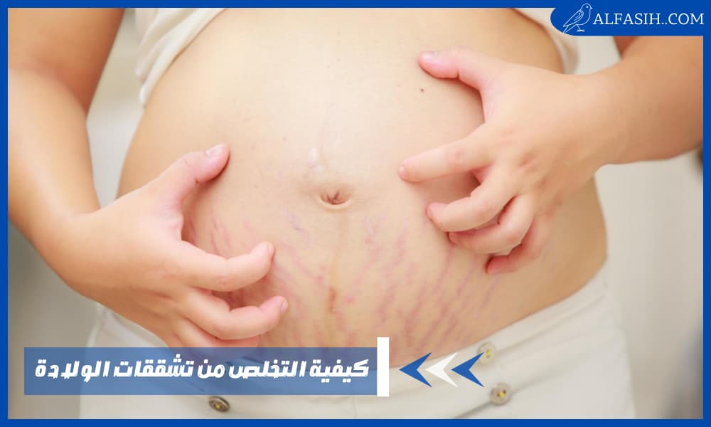 كيفية التخلص من تشققات الولادة
