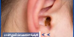 كيفية التخلص من شمع الأذن وأعراض انسداد الأذن وأسباب تكوين الشمع
