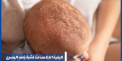كيفية التخلص من قشرة رأس الرضيع وأسباب ظهورها