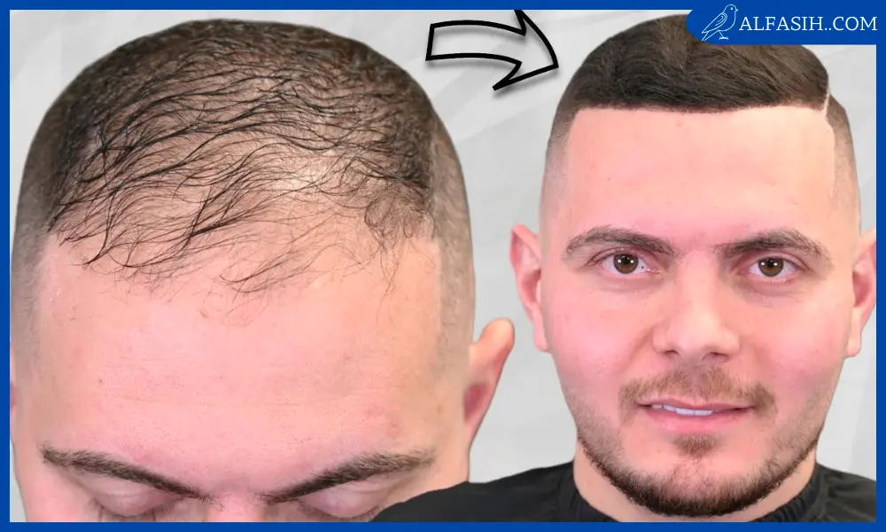 كيفية علاج الشعر الخفيف1